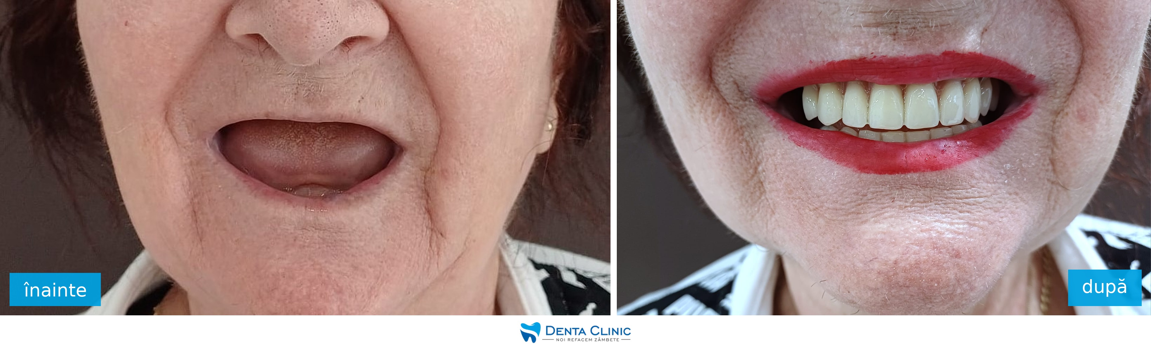 Transformare dentară 1