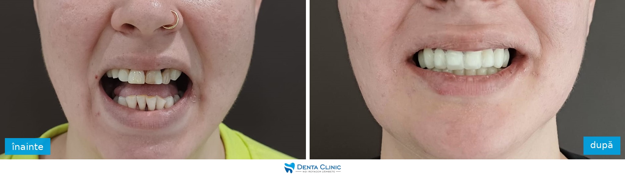 Transformare dentară 11