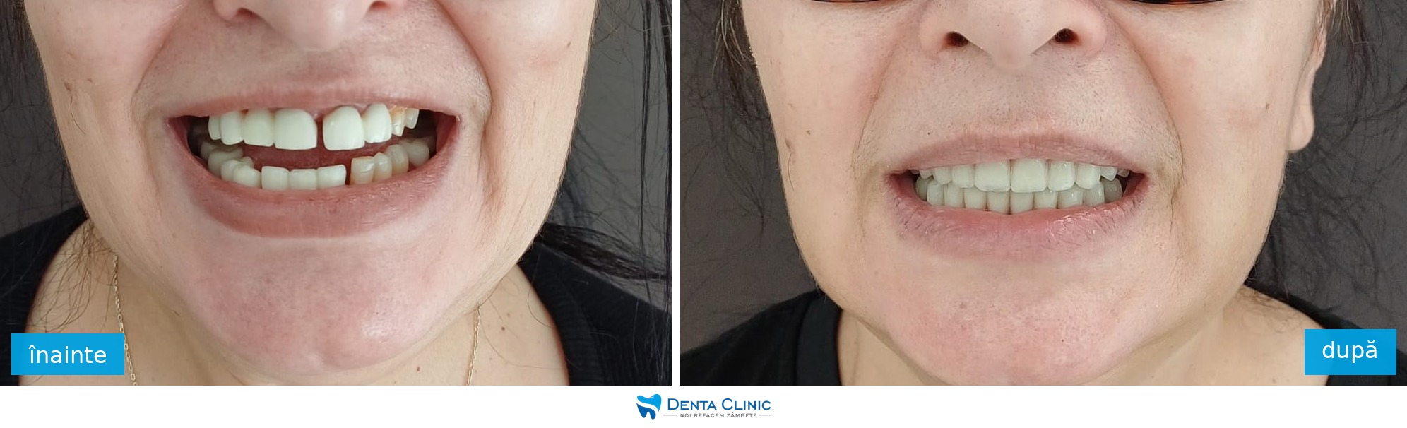 Transformare dentară 12