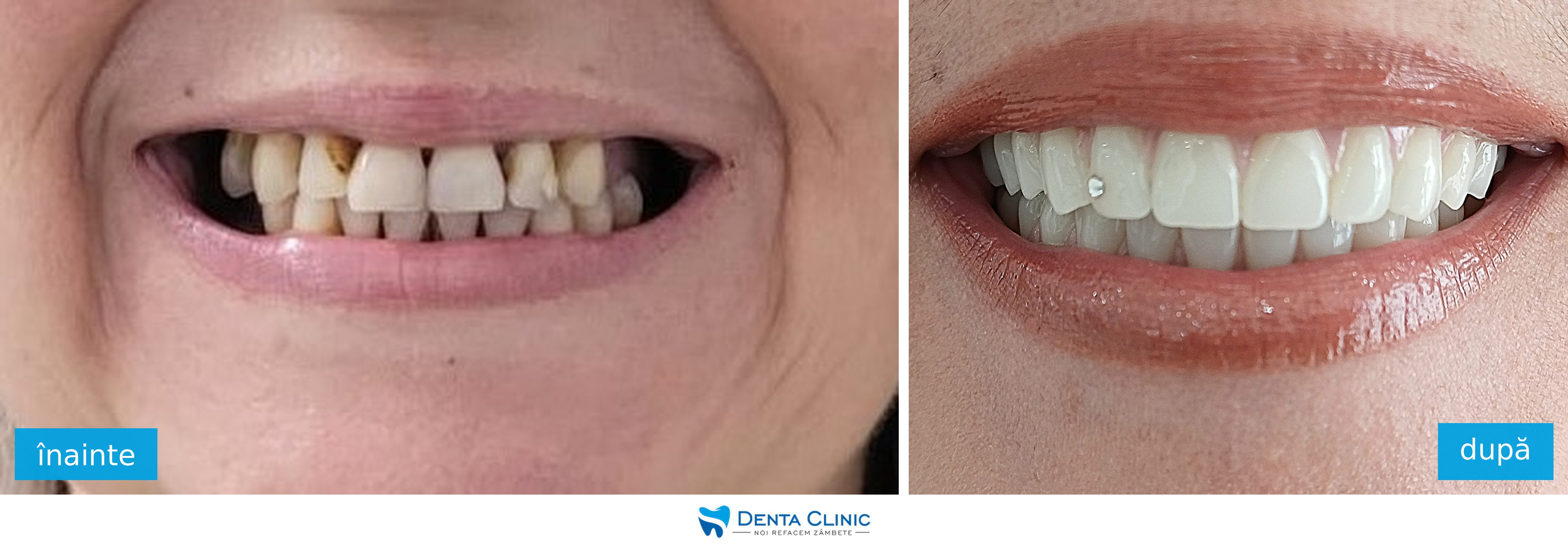 Transformare dentară 2