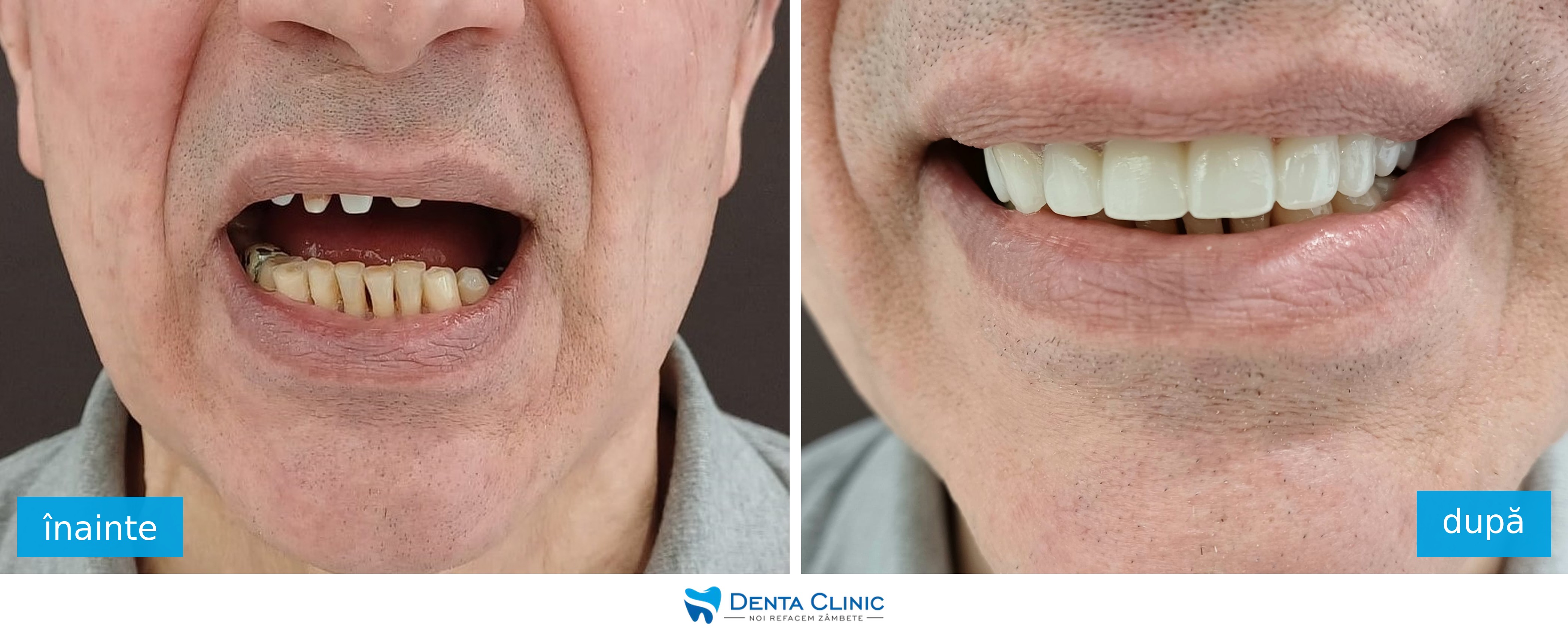 Transformare dentară 3