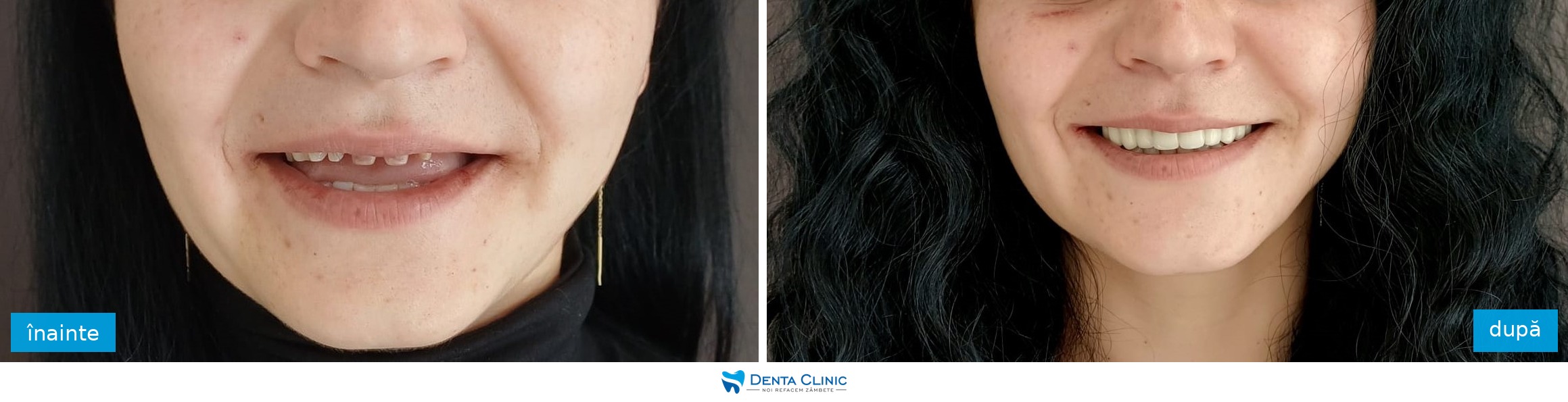 Transformare dentară 4