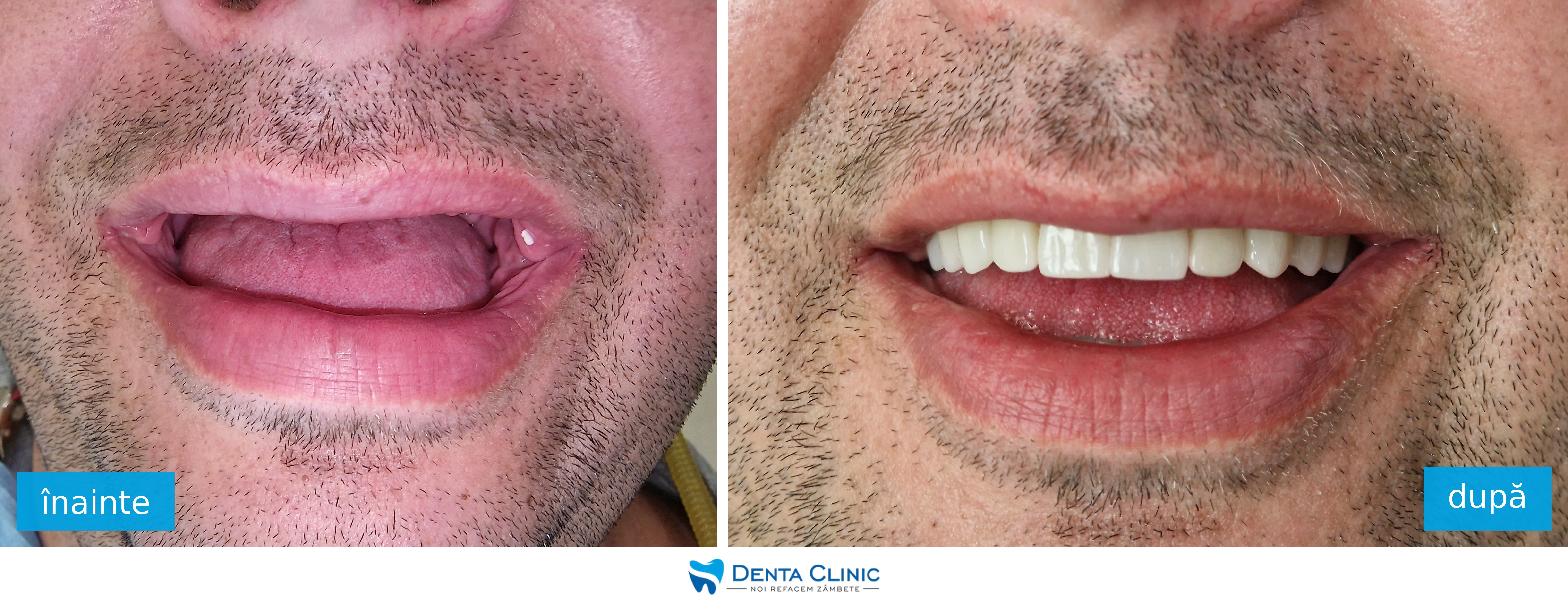 Transformare dentară 5