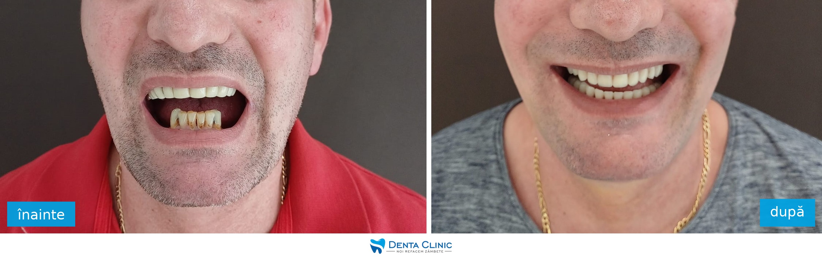 Transformare dentară 9